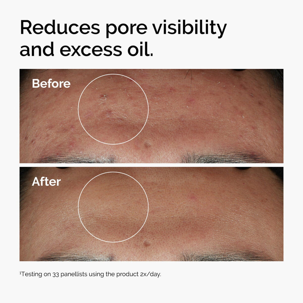 niacinamide-10-zinc-1-n1 ord-niacinamide-zinc-blemish-serum-before-after-pores.jpg