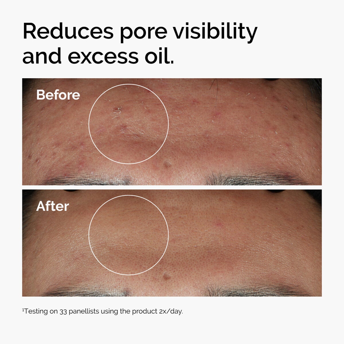 niacinamide-10-zinc-1-n1 ord-niacinamide-zinc-blemish-serum-before-after-pores.jpg