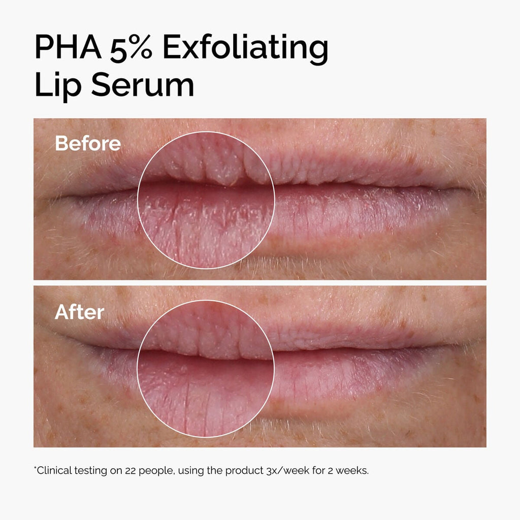 pha-5-exfoliating-lip-serum-o0 ord-pha-5pct-lip-exfoliating-serum-before-after.jpg