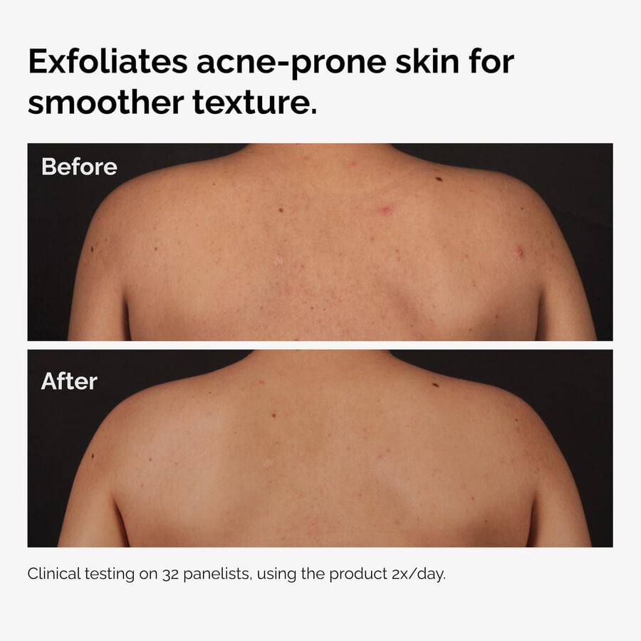 the-body-care-collection-y0 ord-salicylic-acid-body-serum-before-after-graphic-NA.jpg