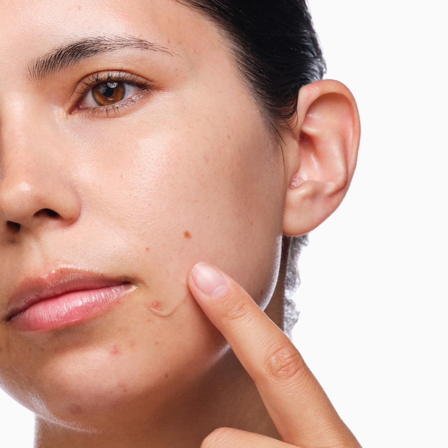 the-acne-set-e5 rdn-the-acne-set-application.png